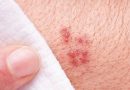 Treatment protocol for Genital Herpes